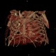Rib fractures after resuscitation: CT - Computed tomography